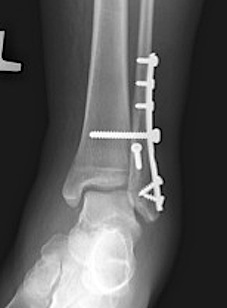 Ankle Weber C Syndesmotic Screw